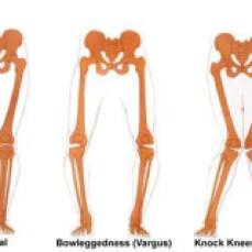 knee positions
