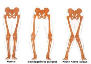 knee positions